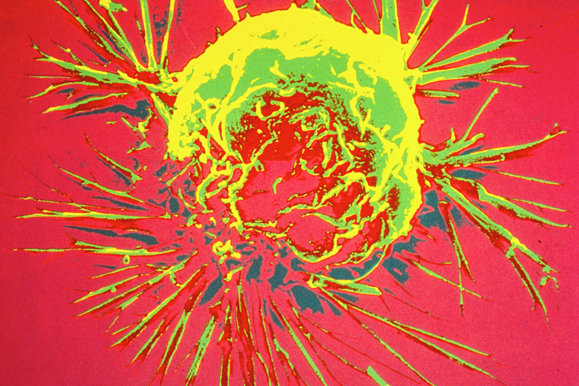 A breast cancer cell show in red, yellow and green.