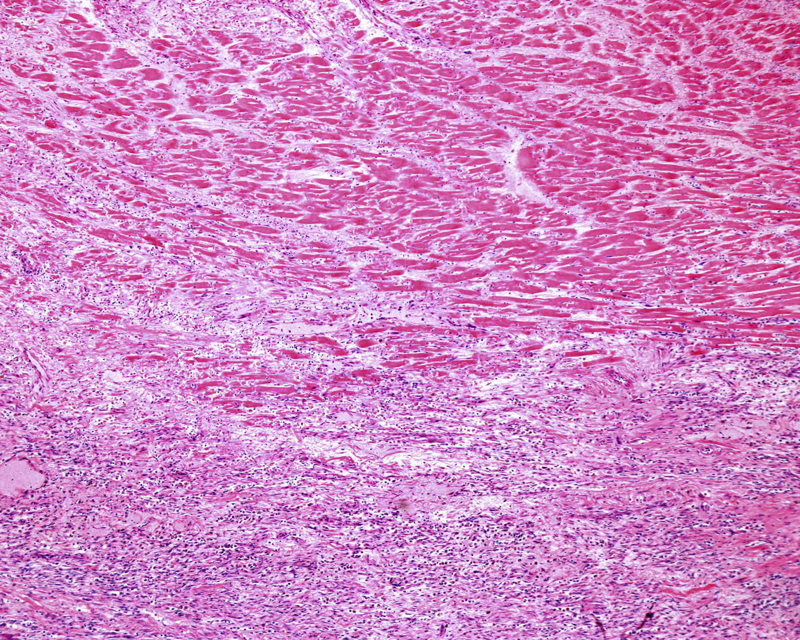 A microscope reveals the difference between scar tissue from a prior heart attack meets (lower half) and healthier living heart muscle tissue (upper half).