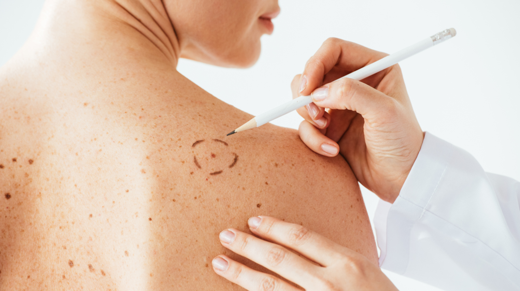 A woman has a spot circled on her back by someone wearing a white coat