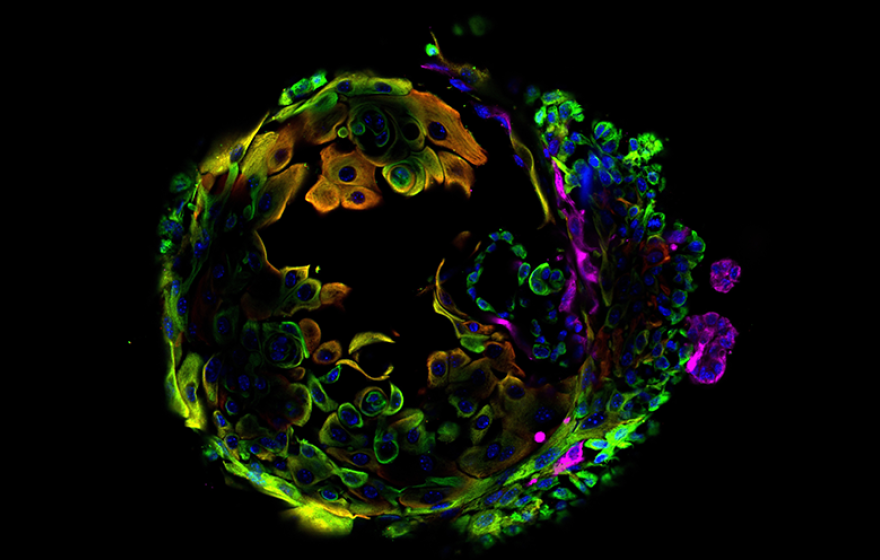 Colorful microscopy showing a breast cancer cell against a dark background