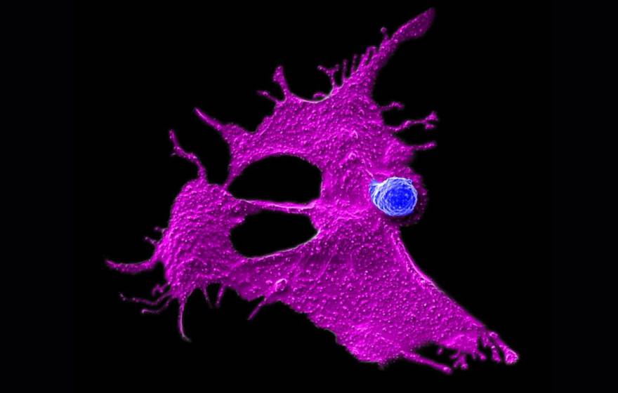 Microscopy image showing a very small stem cell-engineered CAR-NKT cell (blue dot) attacking a human solid tumor cell (magenta spread out, amoeba-like shape)