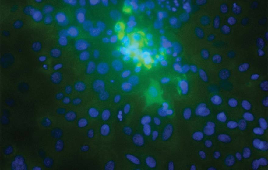 Chorionic villus cells infected by the Uganda strain of Zika virus are stained bright green. Chorionic villi anchor the placenta to the uterus and channel blood from the mother's circulation to the maternal blood space, giving viruses easy access to the f