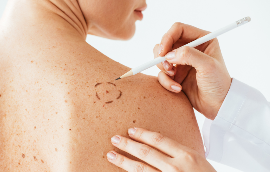 A woman has a spot circled on her back by someone wearing a white coat