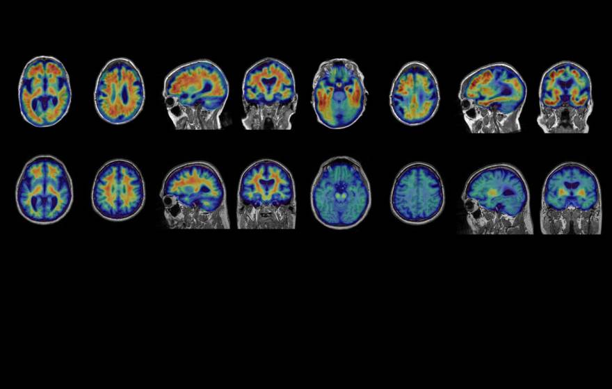 A set of 16 brain PET scans, with orange areas representing Alzheimer's progression