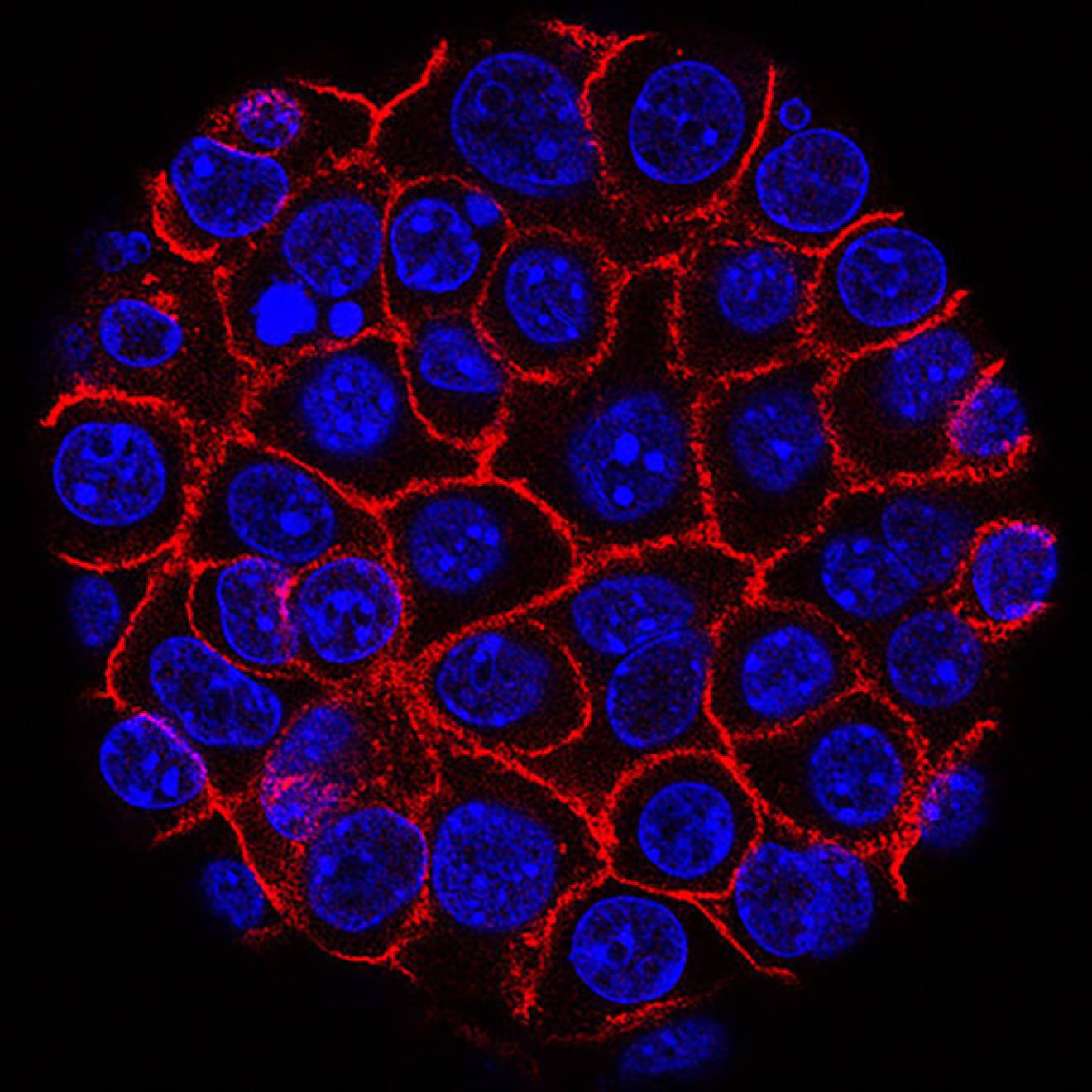 Pancreatic cancer cells